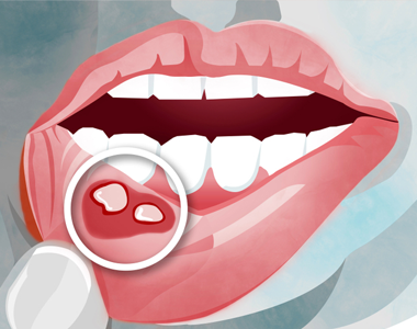 How to Get Rid of Canker Sores Naturally