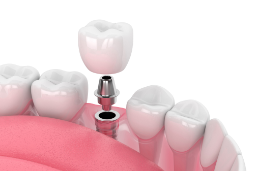 Single Dental Implant