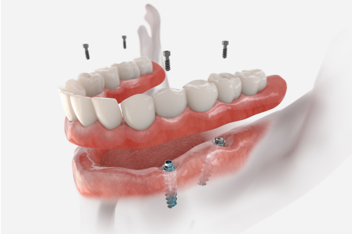 Snap-On Implant Denture